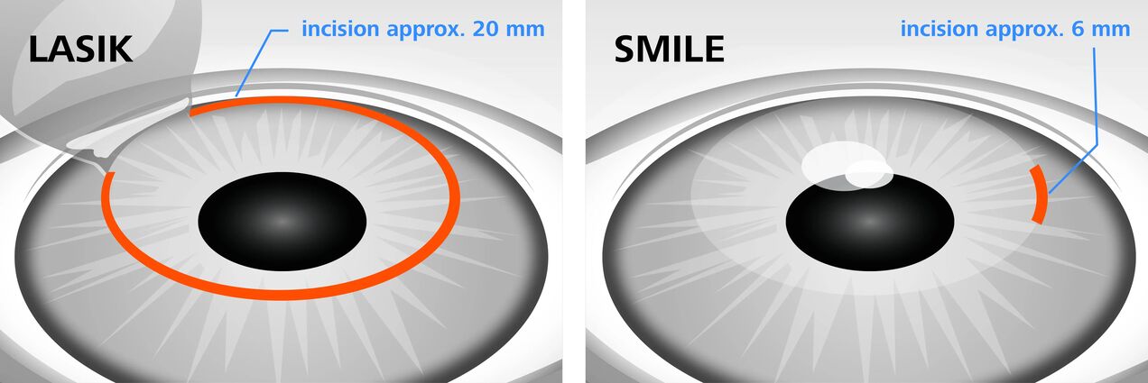 Paghahambing ng mga pamamaraan ng pagwawasto ng laser vision na LASIK at SMILE